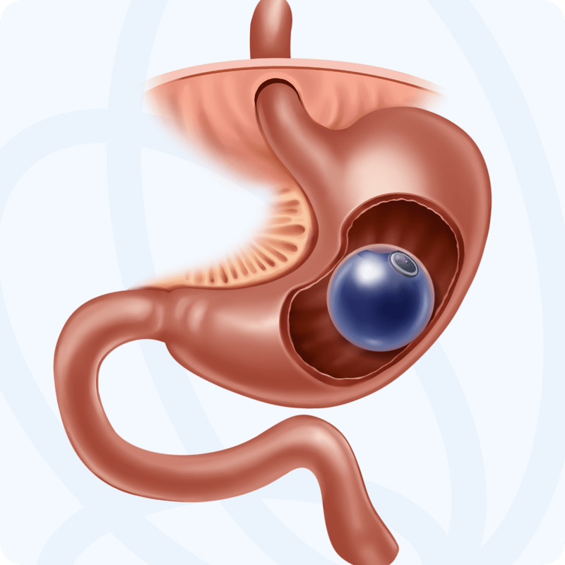 balon_gastrico