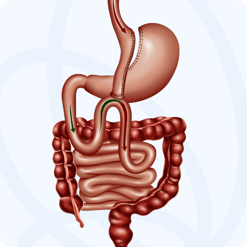 bypass_anastomosis